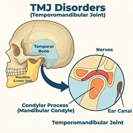 Temporomandibular joint (TMJ) disorder