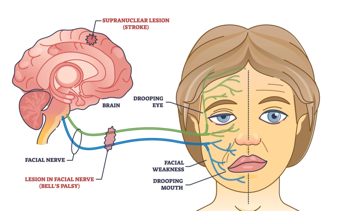 Bells Palsy
