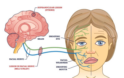Bells Palsy