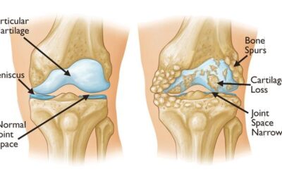 Unlocking the Power of Physiotherapy: How It Can Ease Your Knee Arthritis