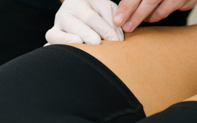 Frozen Shoulder – can Acupuncture help?