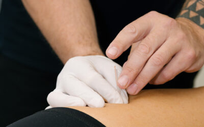 How Does Dry Needling Work? Benefits, Safety, and What to Expect